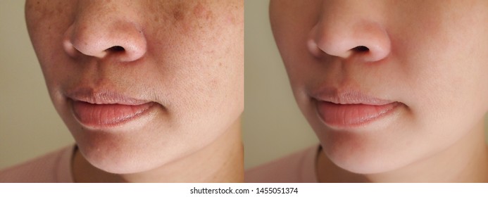 Aging Spots Before After Hd Stock Images Shutterstock