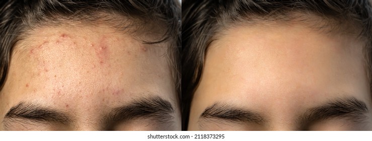 Image compare before and after acne treatment on teenage boy's forehead because of hormone changes. Problem face skin and beauty concept.