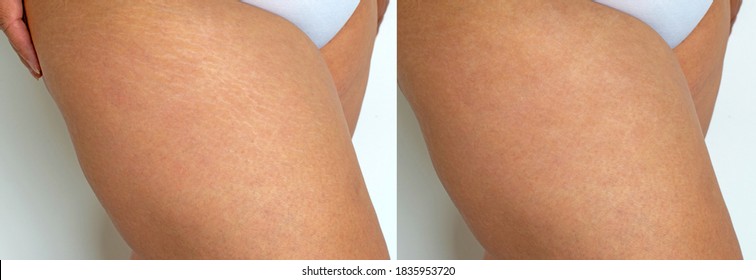 Stretch Marks Removal Williamsville NY - Smooth Solutions