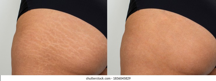 IN 5 DAYS REMOVE STRETCH MARK VERY FAST PERMANENT RESULT USING ONION - Stretch  mark remedies, Aging skin care diy, Stretch mark removal