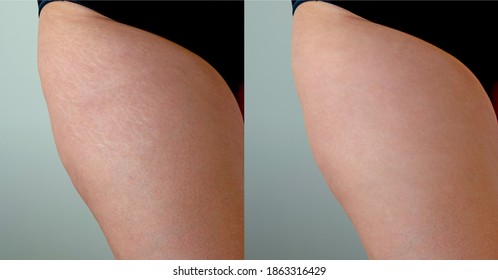 Image compare before and after Woman skin with stretch marks removal treatment, real people. Close up stretch marks on an Asian woman's skin.  Imperfect skin isolated on white background
