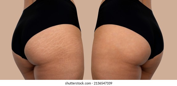 Image Compare Before And After Woman Buttocks, Hip With Stretch Marks Removal Treatment, Real People