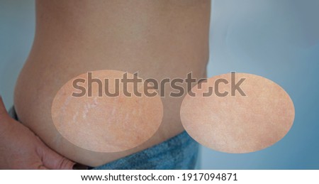 Image compare before and after Woman sidebar belly and back with stretch marks scars from pregnancy removal treatment, real people