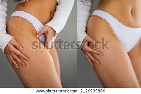 Image compare before and after Woman buttocks with stretch marks removal treatment, real people