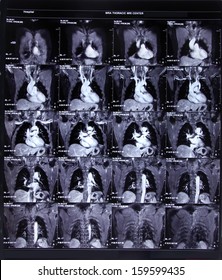 Image Of CT Scan Chest And Heart