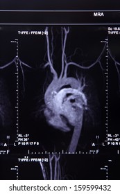 Image Of CT Scan Coronary Artery And Circulation System Of Heart