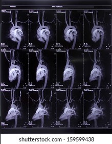 Image Of CT Scan Coronary Artery And Circulation System Of Heart