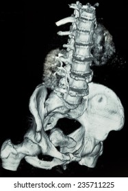 Image Of CT Scan Left Side Renal