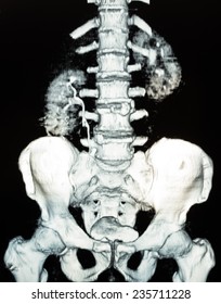 Image Of CT Scan Renal