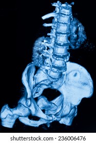 Image Of CT Scan Renal And Sacrum