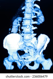 Image Of CT Scan Renal And Sacrum