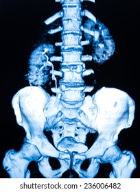 Image Of CT Scan Renal And Sacrum