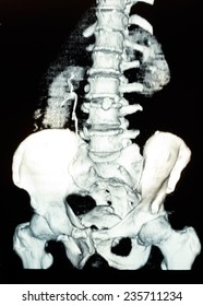 Image Of CT Scan Right Side Renal