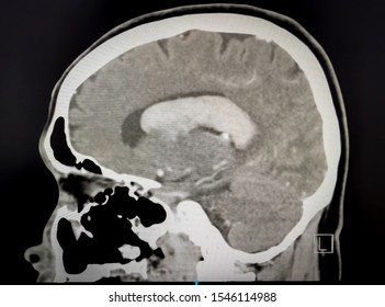 Image Of CT Scan Showing Intraventricular Hemorrhage - Sagittal View