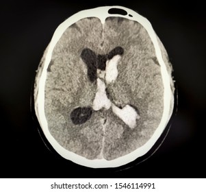 Image Of CT Scan Showing Intraventricular Hemorrhage - Axial View