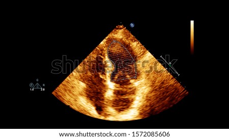 Image of the heart in gray-scale mode during transesophageal ultrasound.