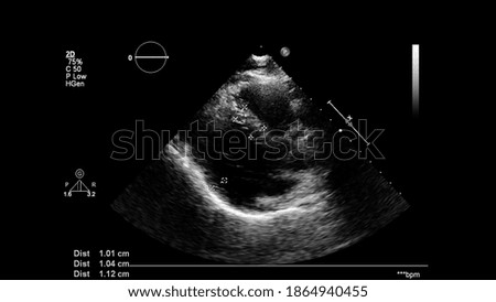 Image of the heart in gray-scale mode during transesophageal ultrasound.