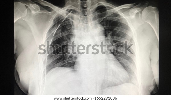 Image Human Chest Xray Thorax Intercostal Stock Photo 1652291086 