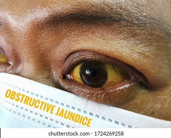 Image Of Jaundice Patient With Yellowish Discolouration Of Eyes.