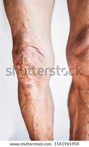 The image of the knees and legs of an aging person