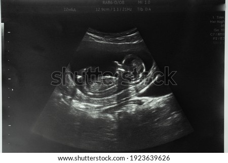 Image of mother's womb ultrasound during pregnancy. Ultrasound of a fetus at 12 weeks 6 days. Length 12,9 cm.