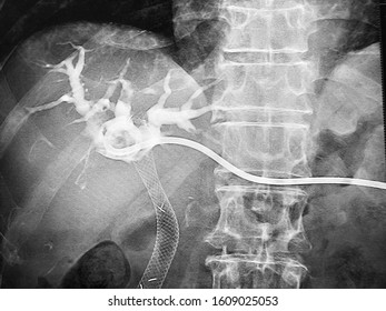 Image Of Percutaneous Transhepatic Biliary Drainage (PTBD). The Catheter With Contrast Media Insertion And Biliary Metal Stent To Hold Bile Duct Open, Which Has Been Blocked Or Partially Blocked.