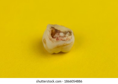 Image Removed Tooth Decay Childs Milk Stock Photo 1866054886 | Shutterstock