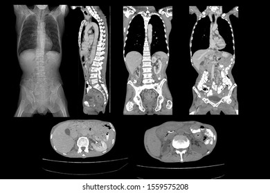 Ct whole abdomen Images, Stock Photos & Vectors | Shutterstock