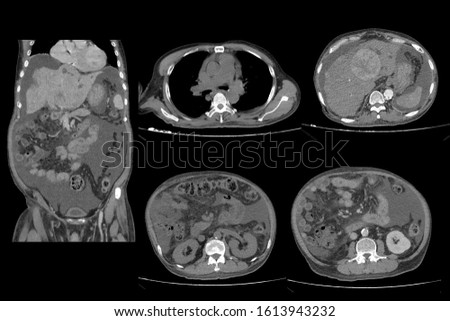 Image show CT whole abdomen and liver metastasis and lung cancer