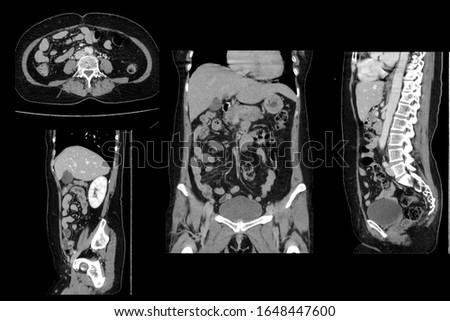 Image show CT Whole abdomen
