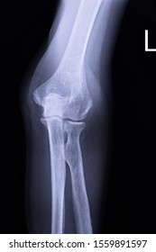 Image Show Xray Elbow Left