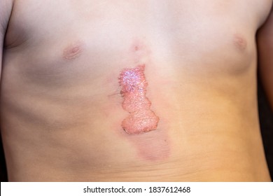 Image Of Skin With Thermal Burn Of Second Degree Injury Of Skin After Boiling Water.