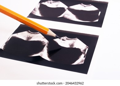 Image Of An Ultrasound Scan Of The Prostate Close Up