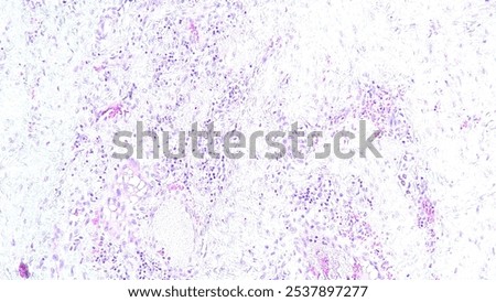 image under the microscope of non-specific chronic inflammation in septic arthritis in the anatomical pathology laboratory