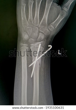 X-ray​  image, X-ray​ wrist​ joint​ AP​ and​ Lateral​ view,  show​  distal​ radi​us​ fracture​ after​ surgery.