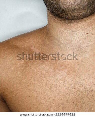 image of white spots on the skin of a man's chest due to fungus, pityriasis versicolor.  Malassezzia furfur