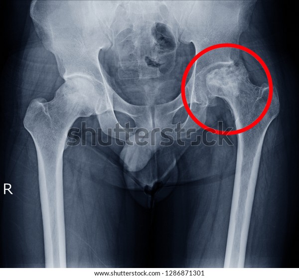 image-xray-hip-showing-left-femoral-stock-photo-edit-now-1286871301