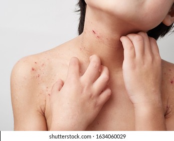 Images Of Atopic, Dry Skin And Dermatitis In Children