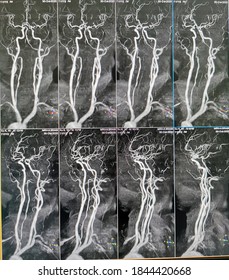 Vertebral artery