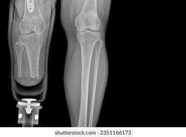 
Images of the legs while wearing prostheses and x-rays of the legs to see abnormalities of the leg bones. normal tone black background