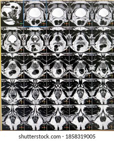 Mri​ Images, Mri​ Prostate​ ​gland​ , Axial​ And​ Coronal​ Plan.