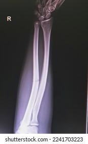 X-ray​ images, film​ Rt.​ Forearm​ AP-Lateral.​ show​ transverse  fracture​ of​ ulna. - Shutterstock ID 2241703223