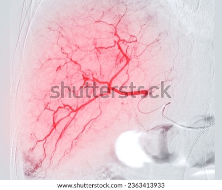 Imaging of TACE or Chemoembolization is a procedure that allows a dose of chemotherapy drugs to be administered directly to Liver tumor or HCC showing hepatic artery.