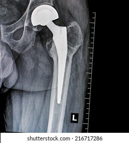  Imaging Xray Of Permanent Total Hip Arthroplasty