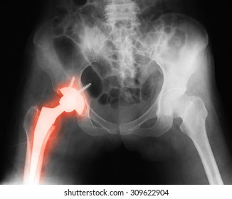 Immediate postoperative x-ray image of both hip, AP view. Showing total hip replacement at left side.