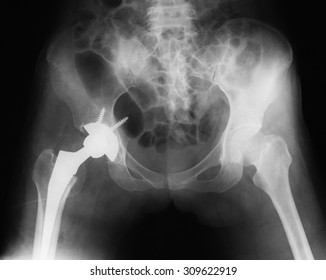 Immediate postoperative x-ray image of both hip, AP view. Showing total hip replacement at left side.