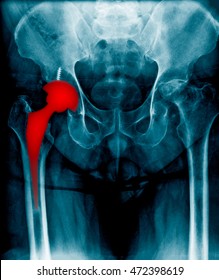 immediate postoperative x-ray image of both hip, anteroposterior view. Showing total hip prosthesis on right side.