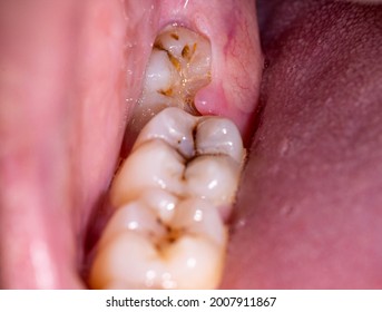 Impacted wisdom tooth due to which a gum hood was formed. Inflammation of the gums due to an unerupted molar, macro - Shutterstock ID 2007911867