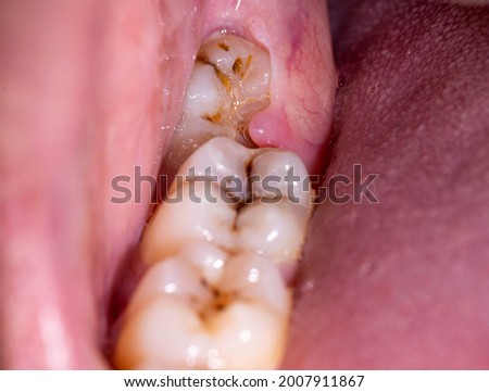 Impacted wisdom tooth due to which a gum hood was formed. Inflammation of the gums due to an unerupted molar, macro