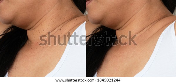 Imperfect Skin texture retouched, skin\
tags removal before and after treatment\
concept